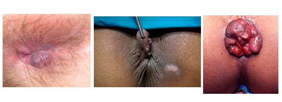 imagenes de hemorroides impactantes